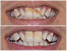 Teeth Whitening in Newton: Recommended Safer Options Given by Dental Experts!