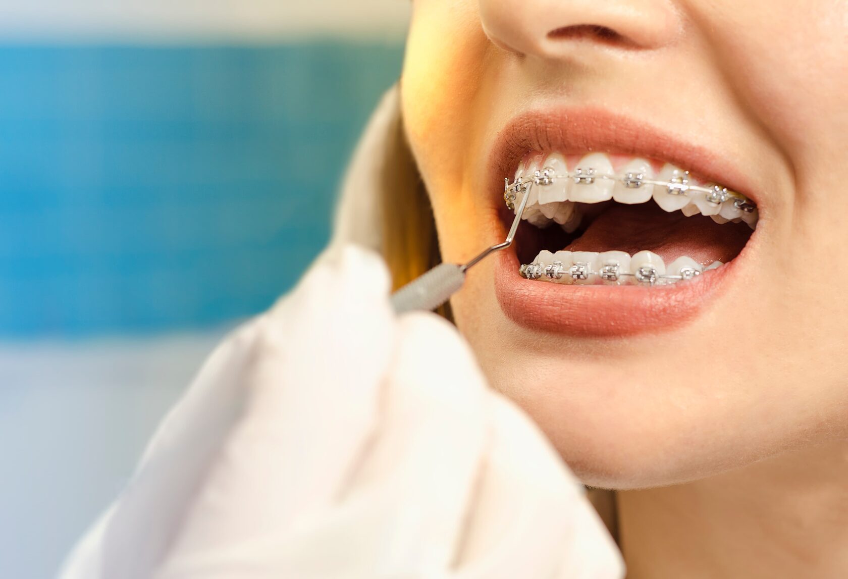 Transforming Smiles: A Guide to Braces Treatment