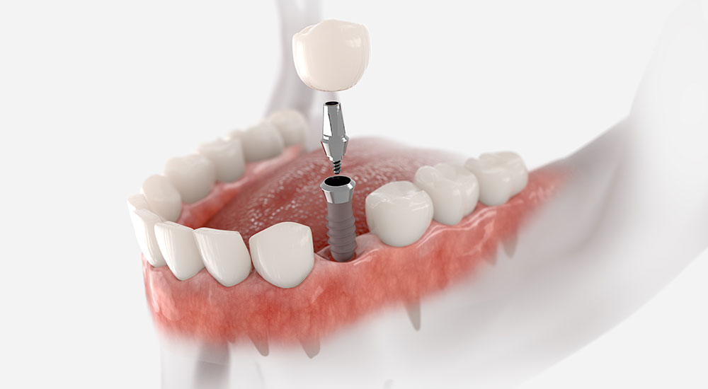 Do Dental Implants Last Forever? Everything You Need to Know About Implant Longevity