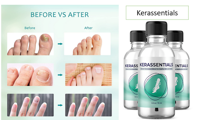 Kerassentials – [Is It Scam or Legit?] Should You Buy?