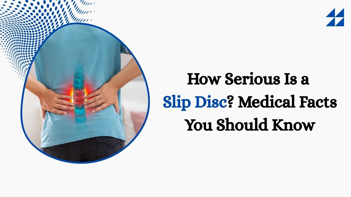 How Serious Is a Slip Disc? Medical Facts You Should Know