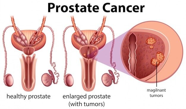 Best Enlarged Prostate Doctors in Delhi for Long-Term Relief