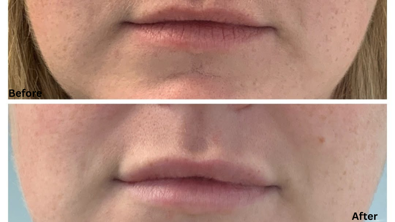 Thinking About Lip Fillers in Rotterdam? Here’s What You Should Know in 2026