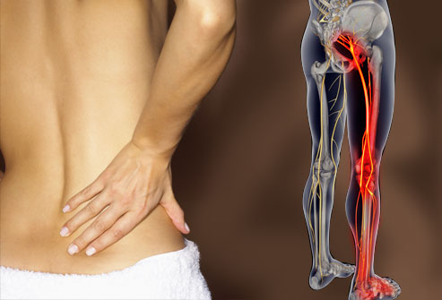 Suffering from Sciatica? Trusted Pain Relief Across the US & Canada