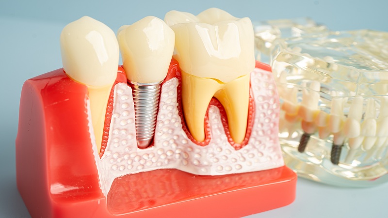 How Do I Know if I’m a Good Candidate for Dental Implants?