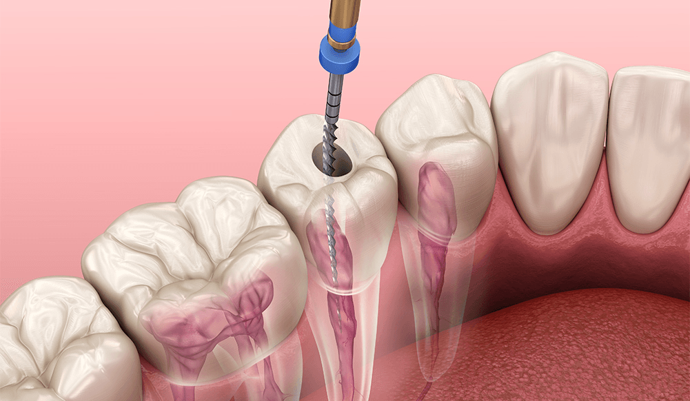 Understanding Your Investment: A Guide to Root Canal Treatment Cost in Parel