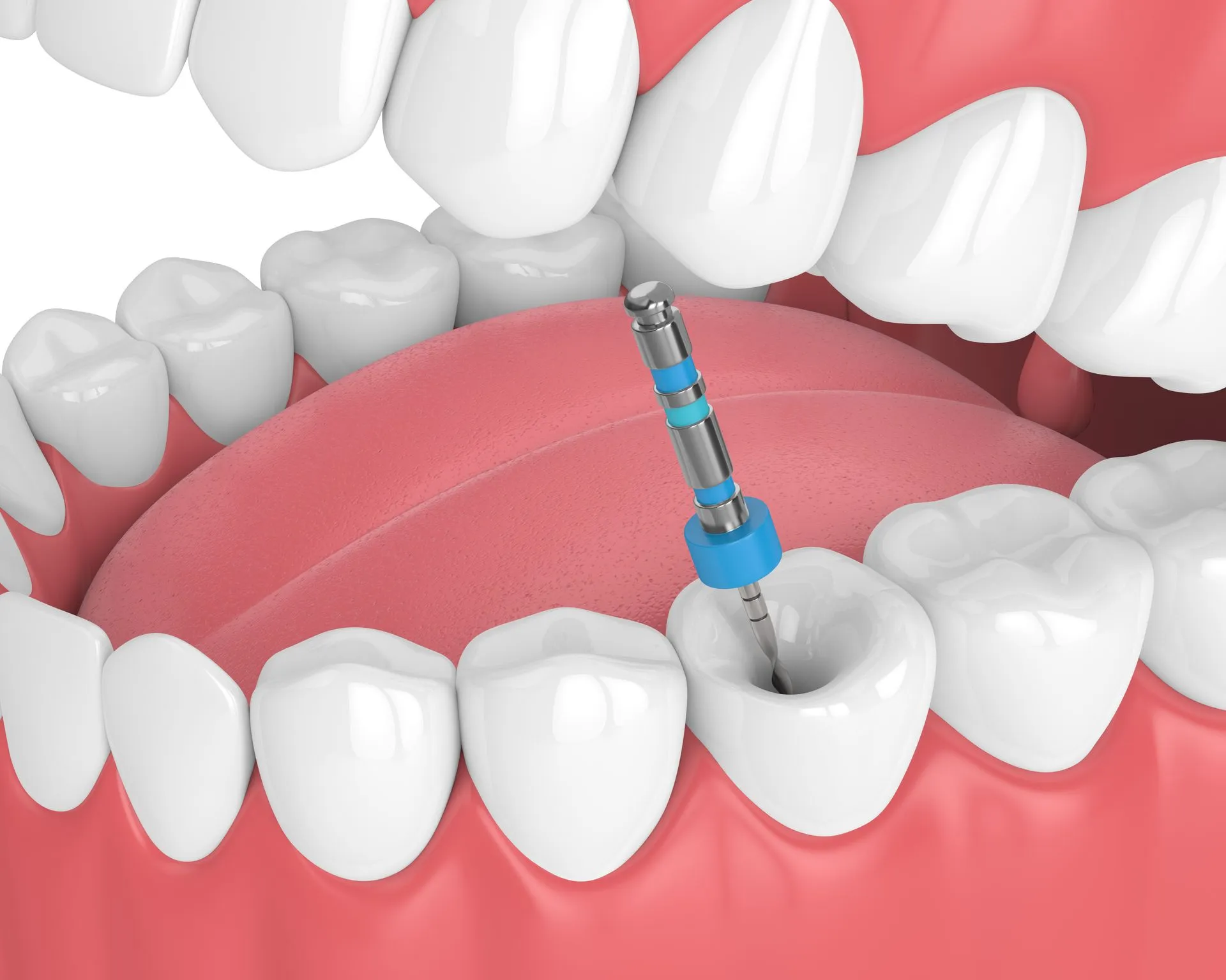 Understanding the Cost of Root Canal Treatment in Parel Mumbai