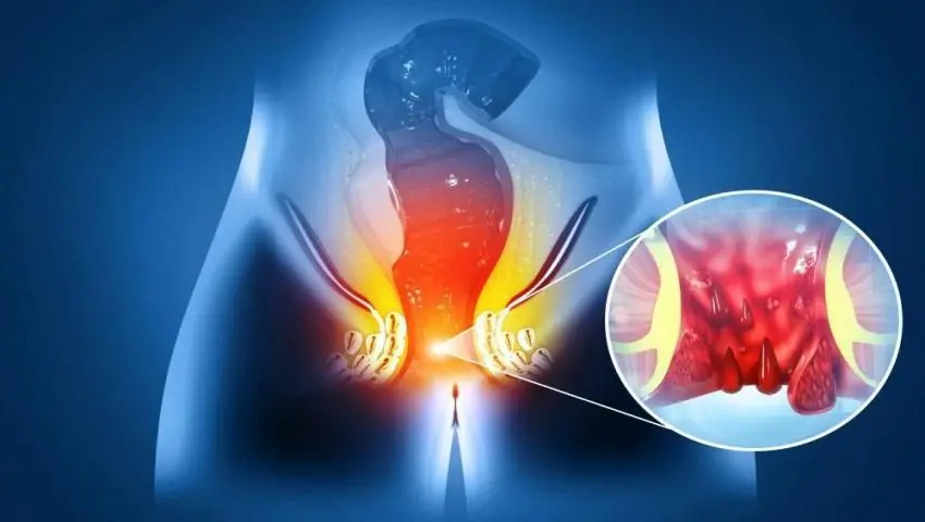 How to Choose the Right Fistula Surgeon?