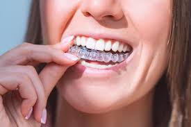What Are Invisalign Aligners and How They Straighten Teeth Comfortably