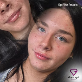 Understanding Laser Hair Removal Somerset and Botox in Somerset