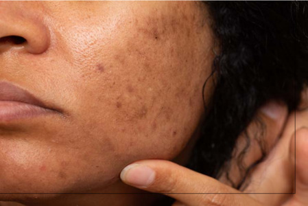 How to Get Rid of Melasma Hyperpigmentation Naturally and Medically