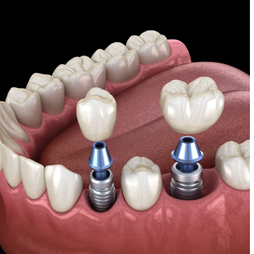 Why Waiting Too Long to Replace a Missing Tooth Can Cost You More Than You Think