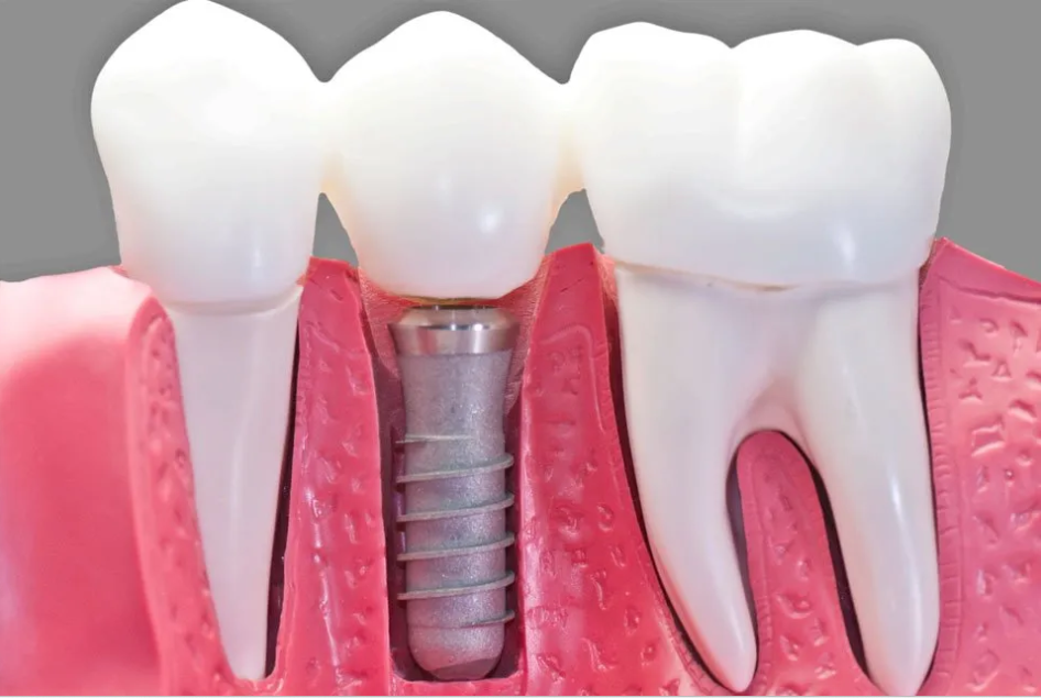 Dental Implants Boynton Beach: A Complete Guide to Restoring Your Smile