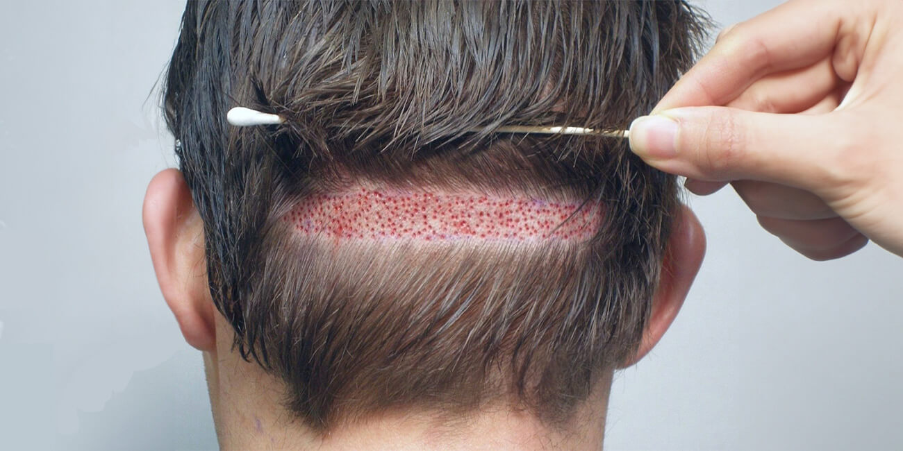 What Makes Someone a Candidate for FUT?