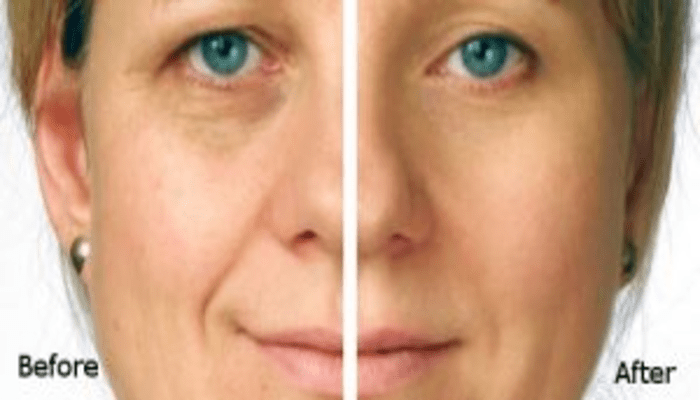 Facial Rejuvenation with PRP (Platelet Rich Plasma) Treatments in Virginia Beach