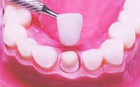 dentures in tennessee