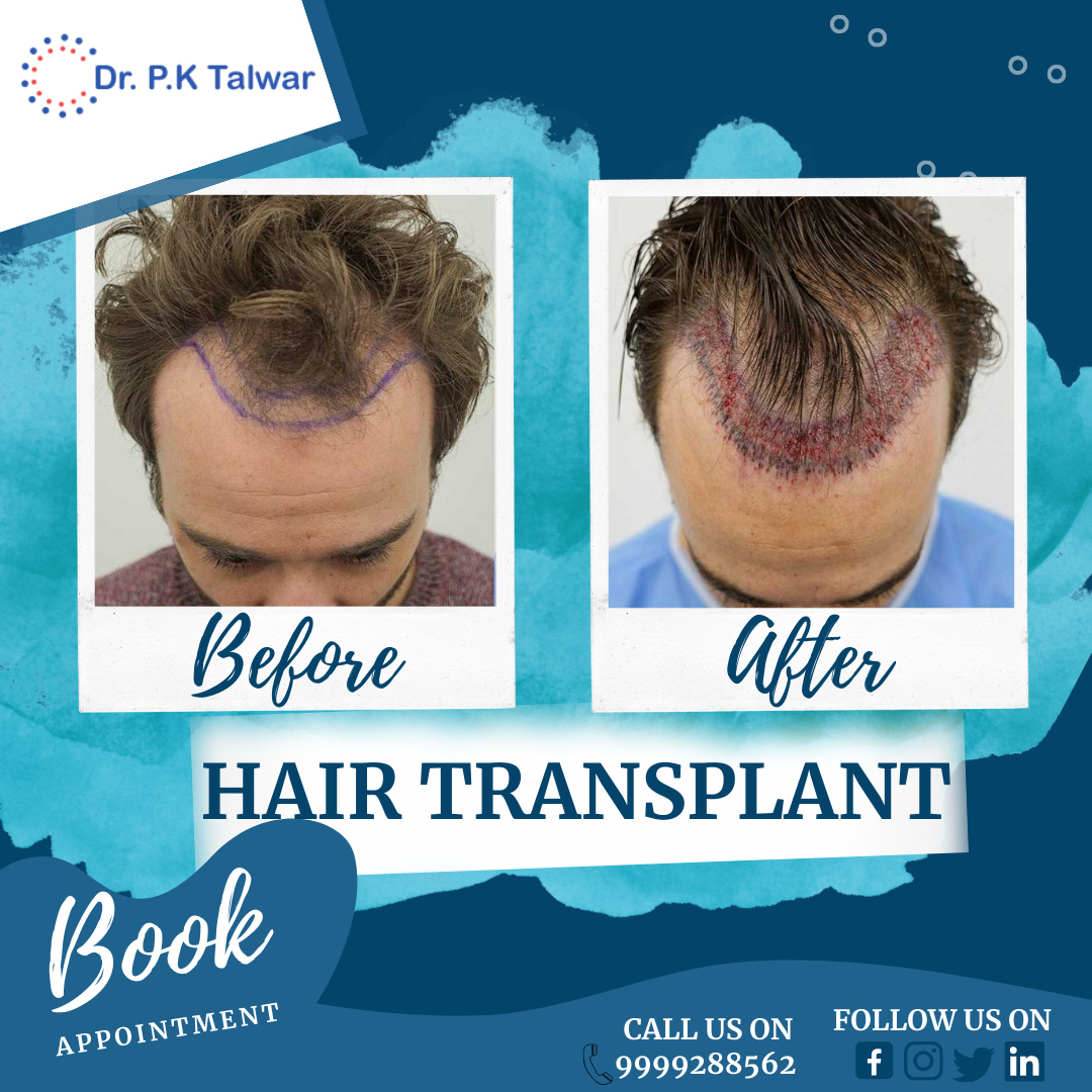 Hair Transplant result before and after