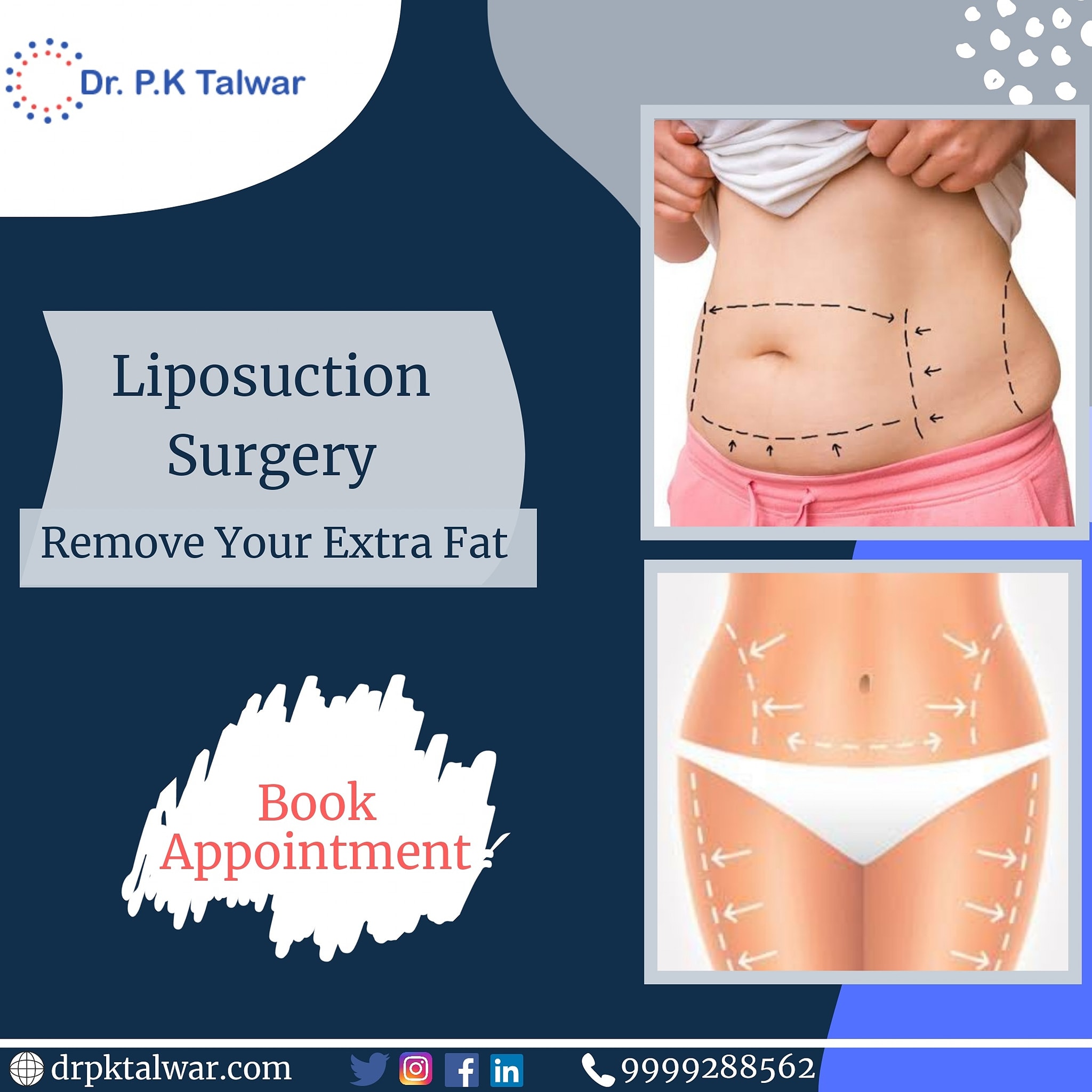 Liposuction Surgery Treatment in Delhi