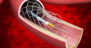 Global Non Vascular Stent Market Report 2020 Forecast to 2025