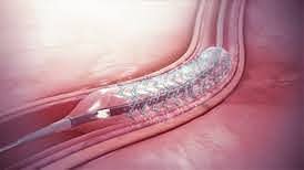 Drug Eluting Stents (DES) Market Analysis | Global Industry Report 2027