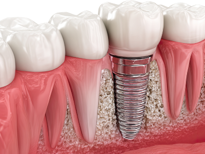 Dental Implants Bandra – Restore Your Smile with Dent Heal