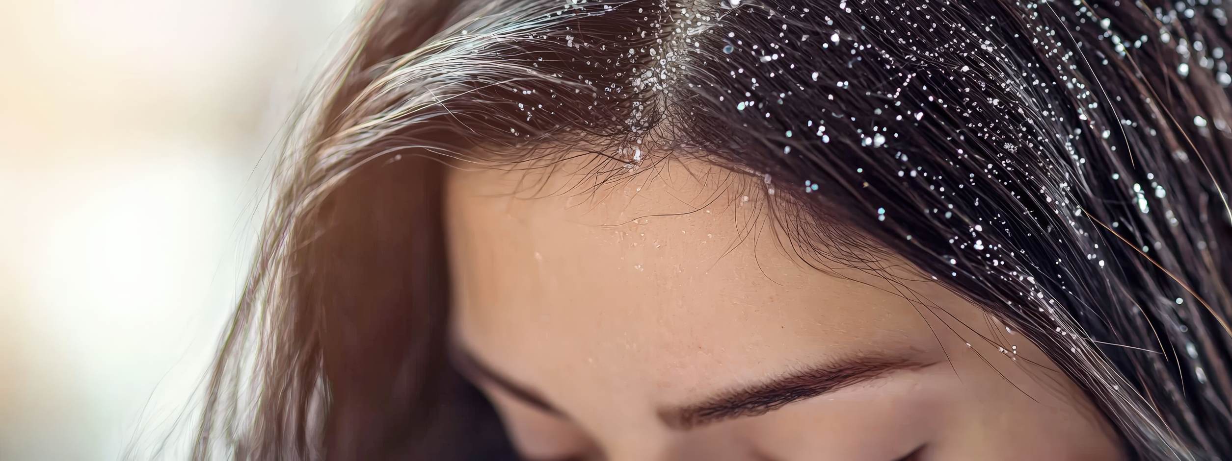 How to Get Rid of Dandruff Permanently with Professional Treatments