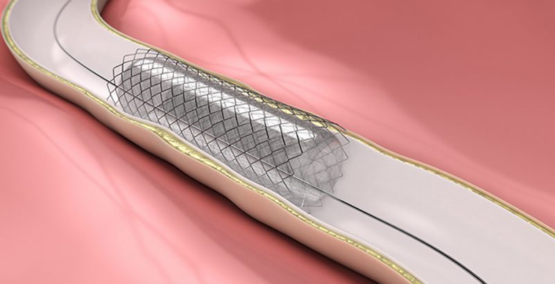 Non-vascular Stents Market 2020 Trends and Review by Quantitative Analysis, Comprehensive Landscape, Current and Future Growth by Forecast to 2025