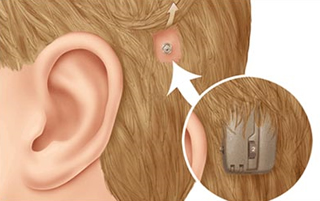 Bone Anchored Hearing Aids Market Growth Powered with Latest Development Scenario and Influencing Trends | Auditdata, Cochlear Limited, GN ReSound