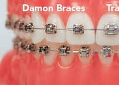 Tooth Aligners Tampa FL