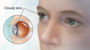 Dr. Leo Ayzenberg ophthalmologist cataract surgery doctor Chicago
