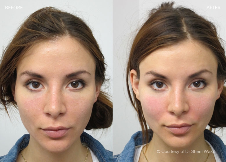 What Are The Best Options For Non-Surgical Cheek Augmentation Surgery?