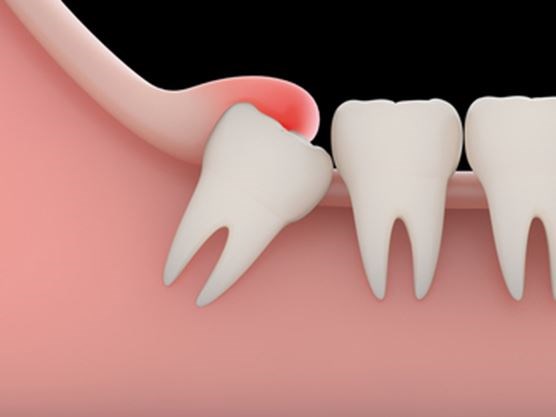 What Is A Wisdom Tooth Emergency?
