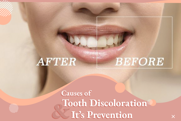 Causes of Tooth Discoloration and Its Prevention