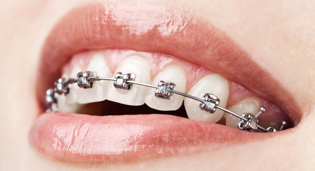 Braces for teens