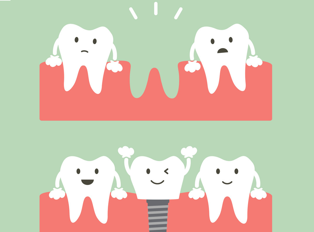 STANDARD DENTAL IMPLANT PROCEDURE