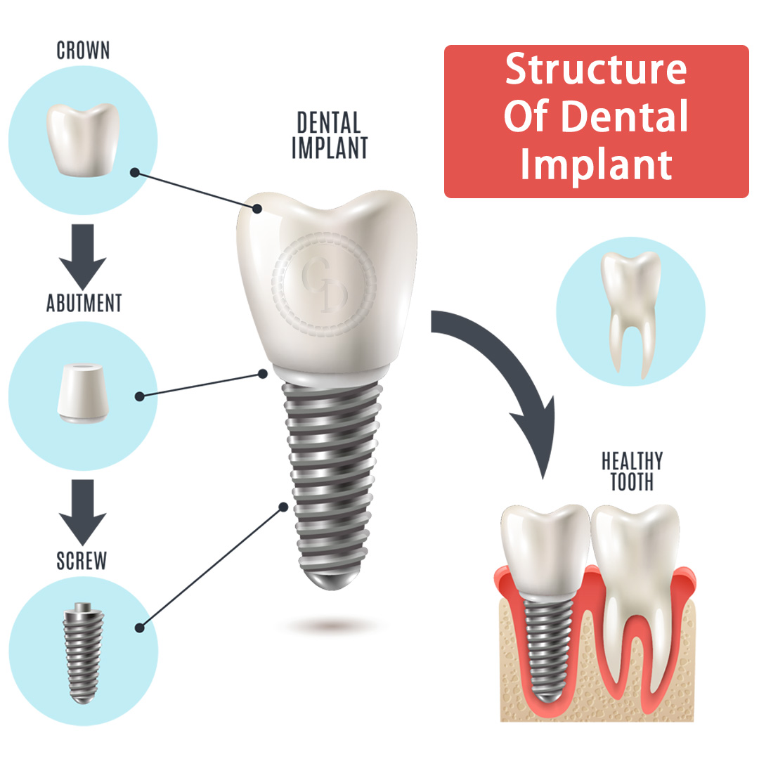 Structure Of Dental Implants