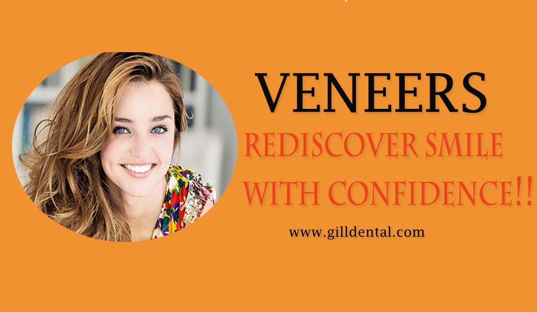 Veneers Dental Implants