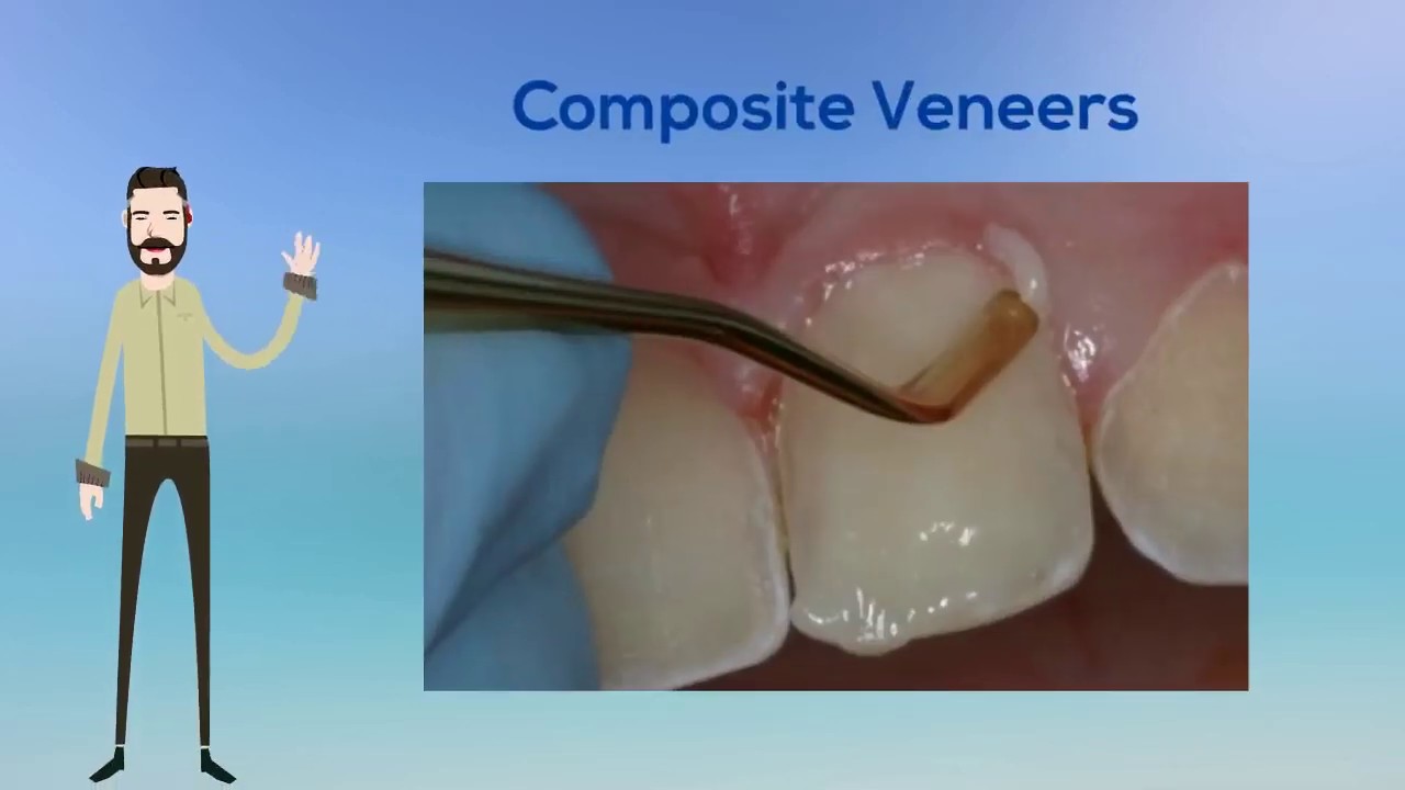 Composite Veneers