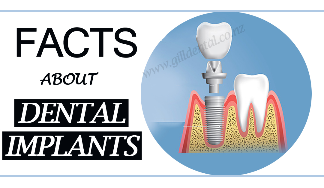 Dental Implants facts to know