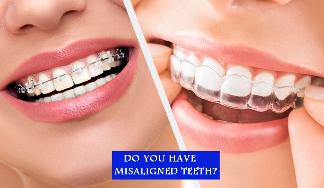 WHY SHOULD YOU CHOOSE CLEAR ALIGNERS OVER BRACES