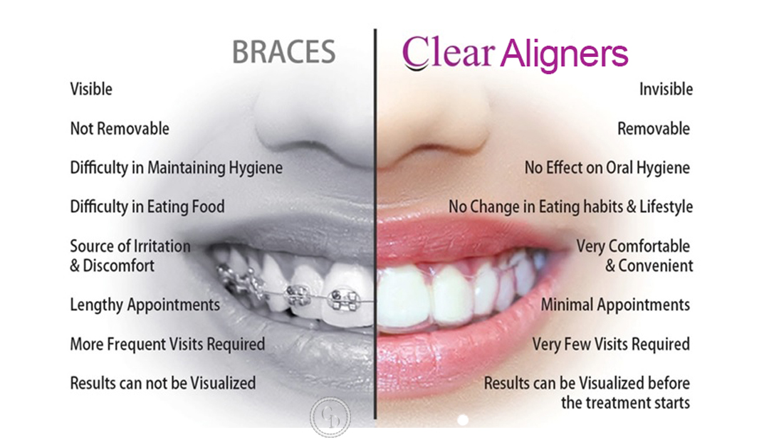 Clear Aligners
