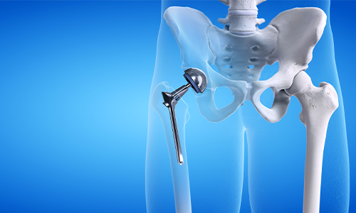 How Successful is Knee Replacement Surgery?
