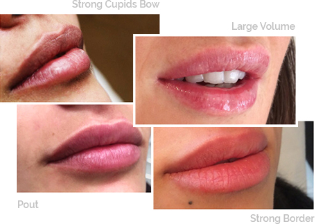 Natural Lip Enhancement Treatment