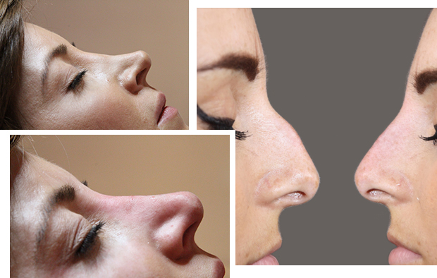 Non Surgical Nose Job