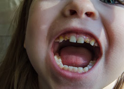 Enamel Hypoplasia – Causes, Effects and Treatments