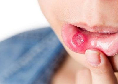 Get rid of the mouth ulcers
