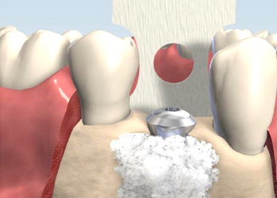 Bone grafting to restore your lost bone in mouth