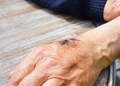 Important Wound Care Tips for Diabetic People