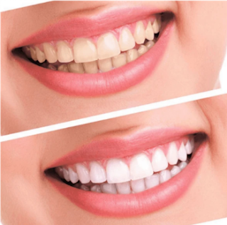 Teeth Whitening