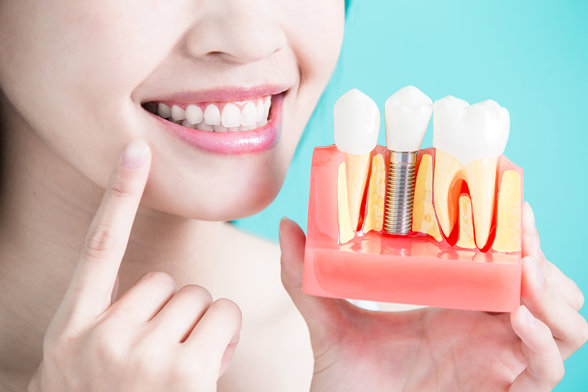 Basic Guidance on How Dental Implant Procedure Works